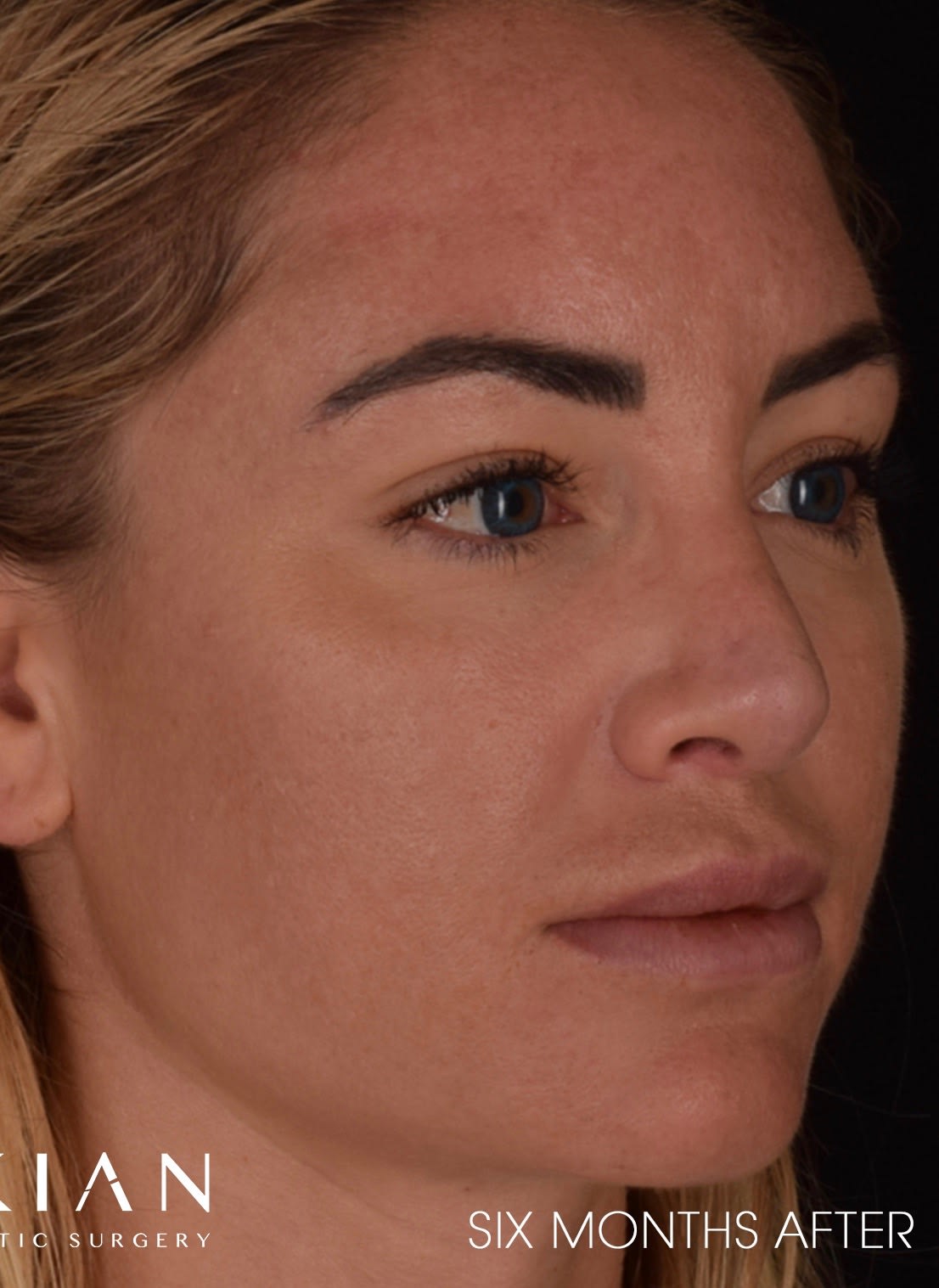 Revision Rhinoplasty After, undefined undefined - 3161