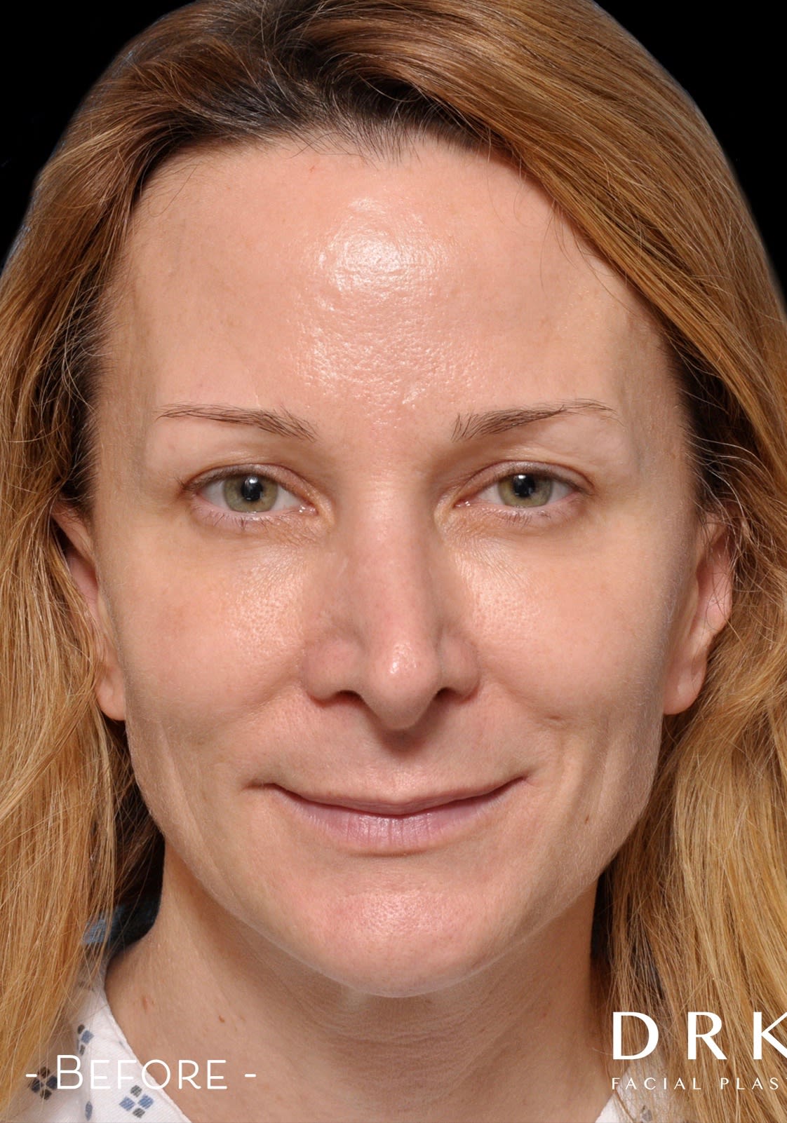 Closed Rhinoplasty Before, undefined undefined - 3157