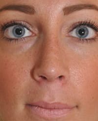 Revision Rhinoplasty Before, undefined undefined - 3207