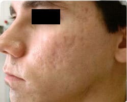 Acne Treatment Before, undefined undefined - 4294