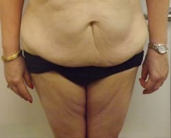 Tummy Tuck (Abdominoplasty) Before, undefined undefined - 4293