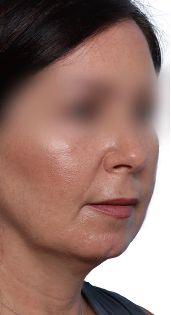 Facelift Before, undefined undefined - 2513