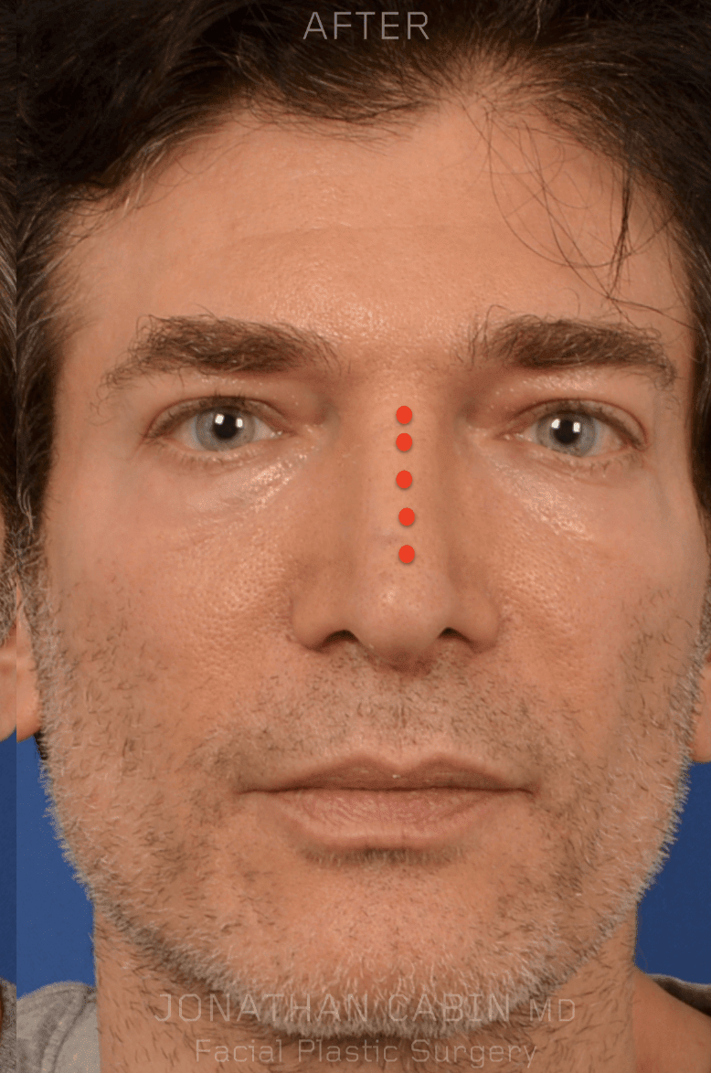 Rhinoplasty After, undefined undefined - 164