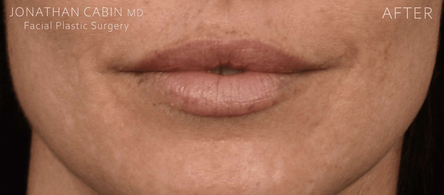 Lip Augmentation and Injections After, undefined undefined - 162