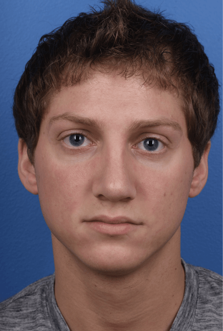 Revision Rhinoplasty After, undefined undefined - 216