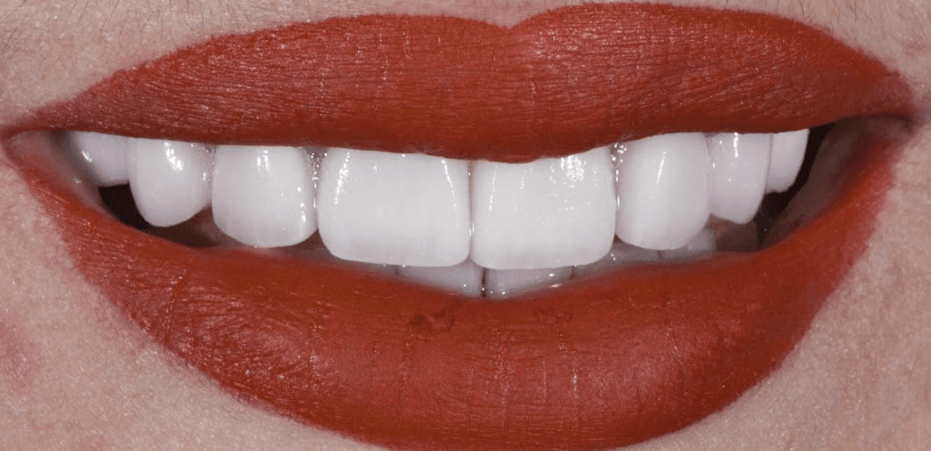 Dental Veneers After, undefined undefined - 227