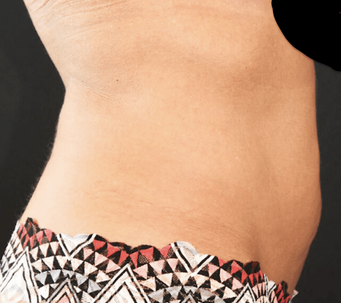 Abdominoplasty Before, undefined undefined - 243