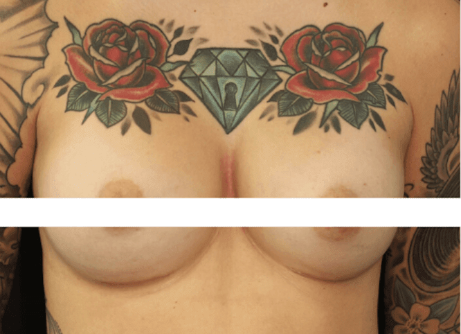 Breast Augmentation with Implants After, undefined undefined - 244