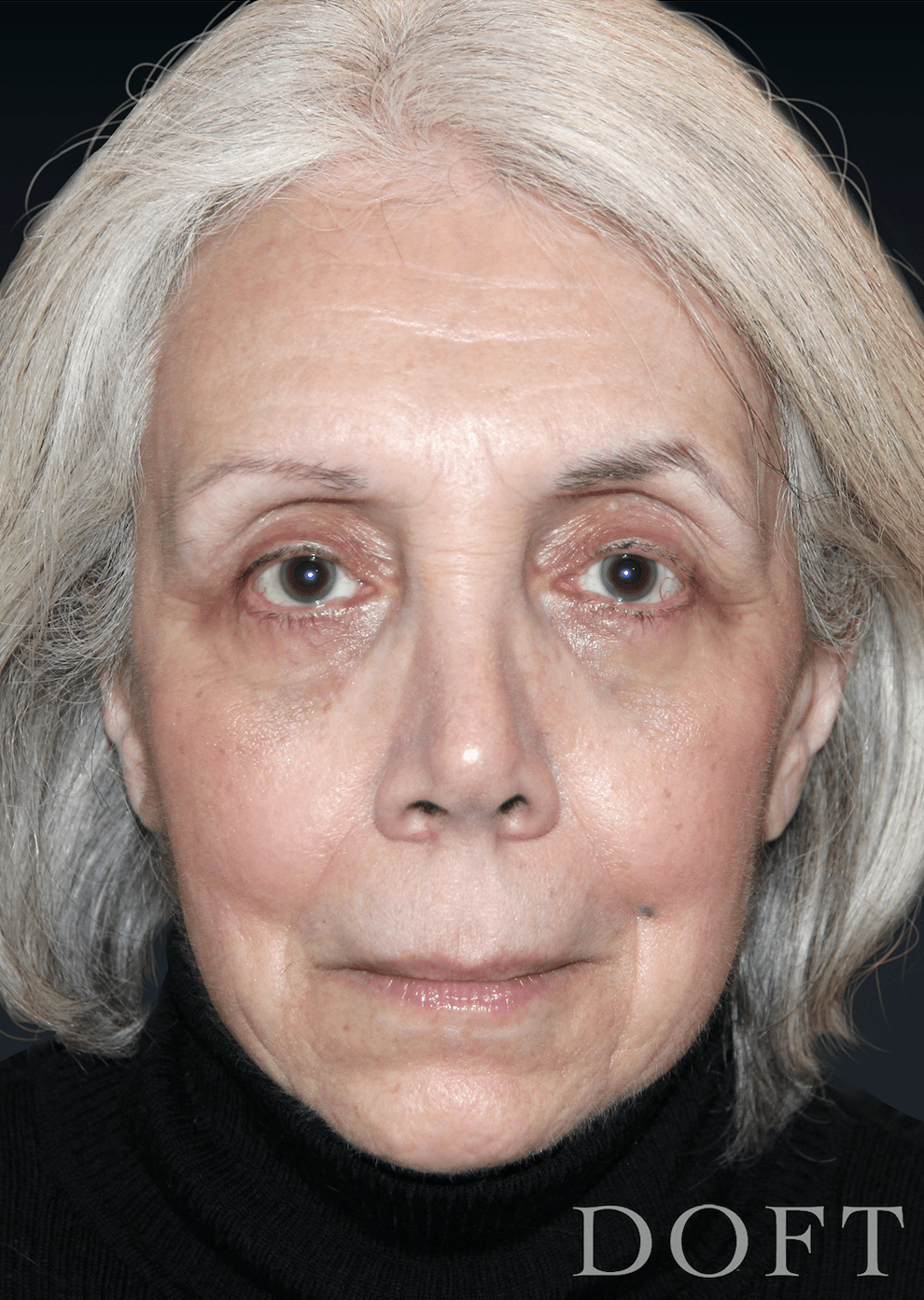 Blepharoplasty After, undefined undefined - 273