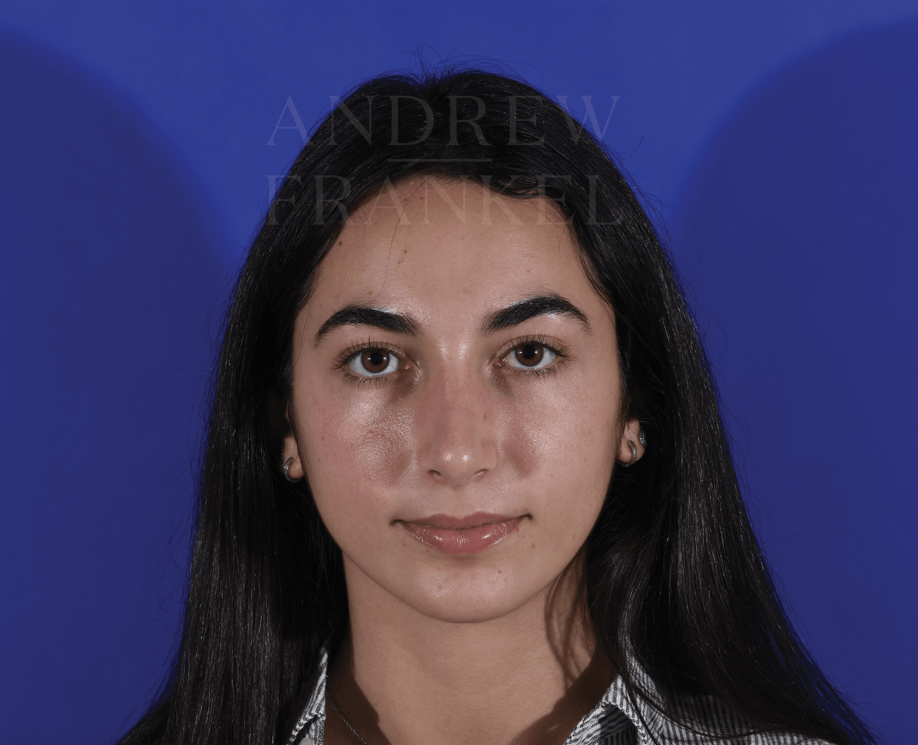 Rhinoplasty After, undefined undefined - 316