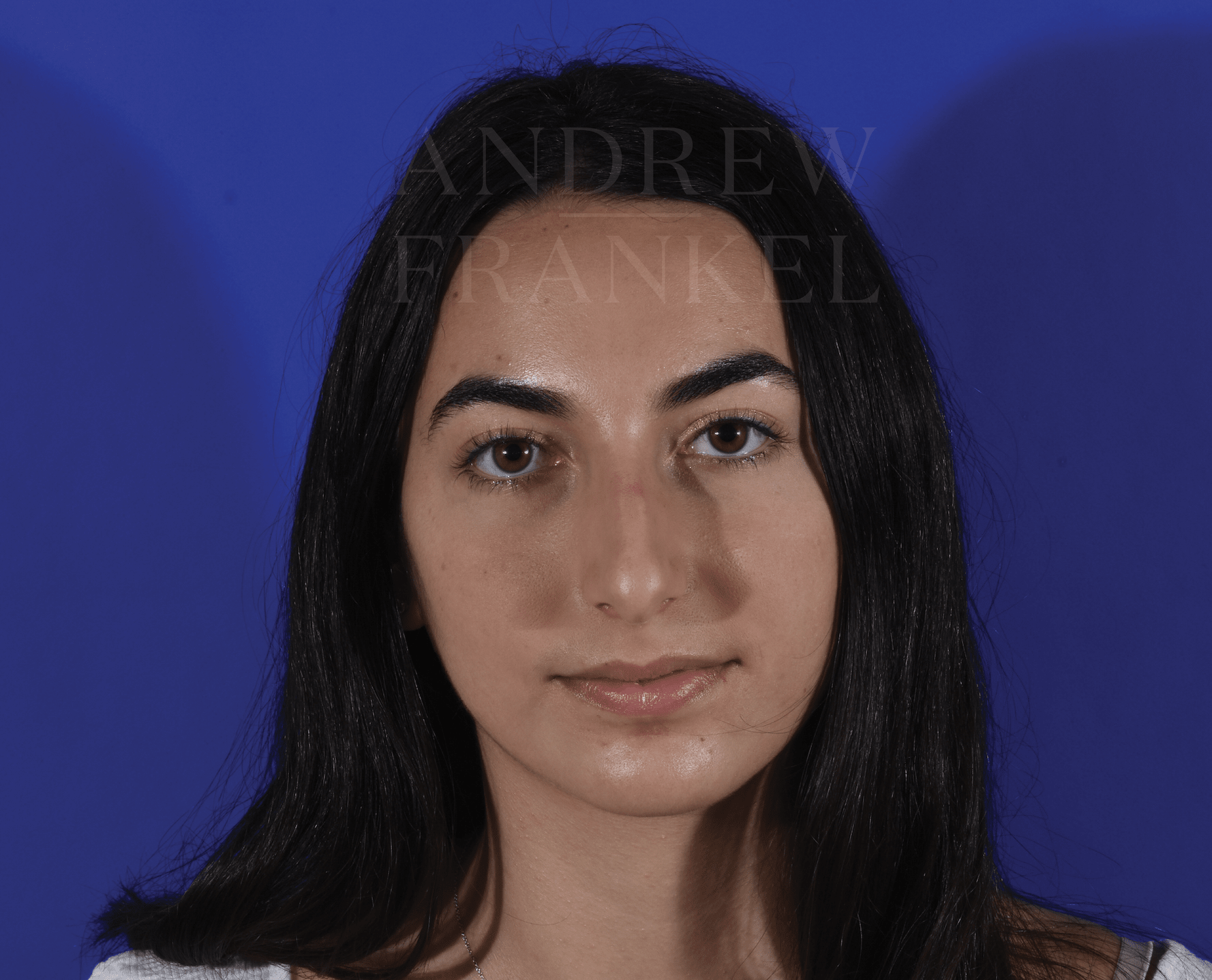 Rhinoplasty Before, undefined undefined - 316