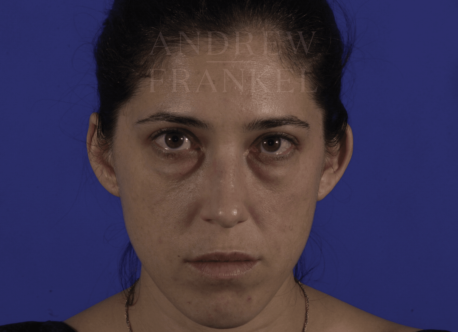 Lower Eyelid Blepharoplasty Transconjunctival Approach Before, undefined undefined - 317