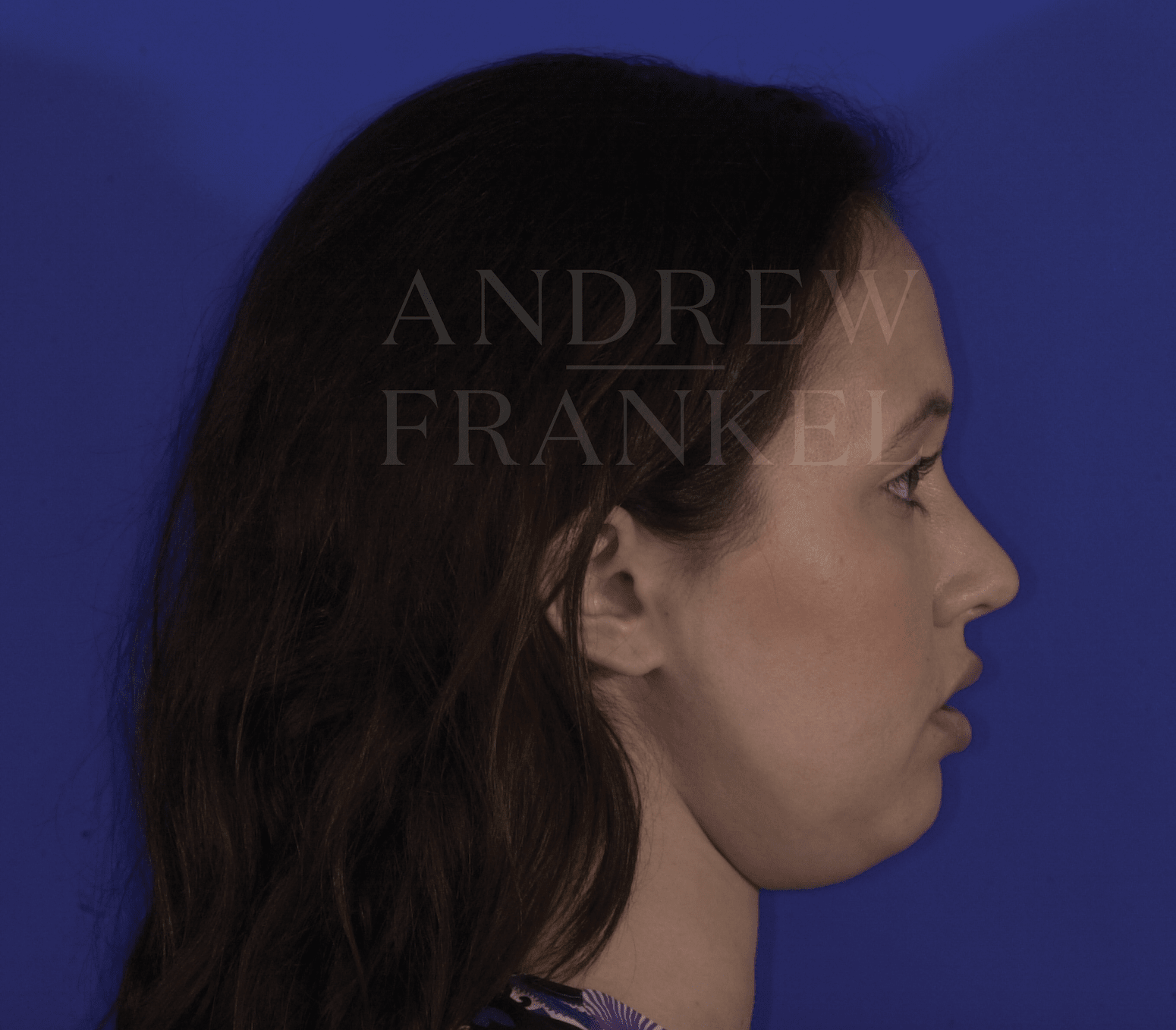Liposuction Before, undefined undefined - 319