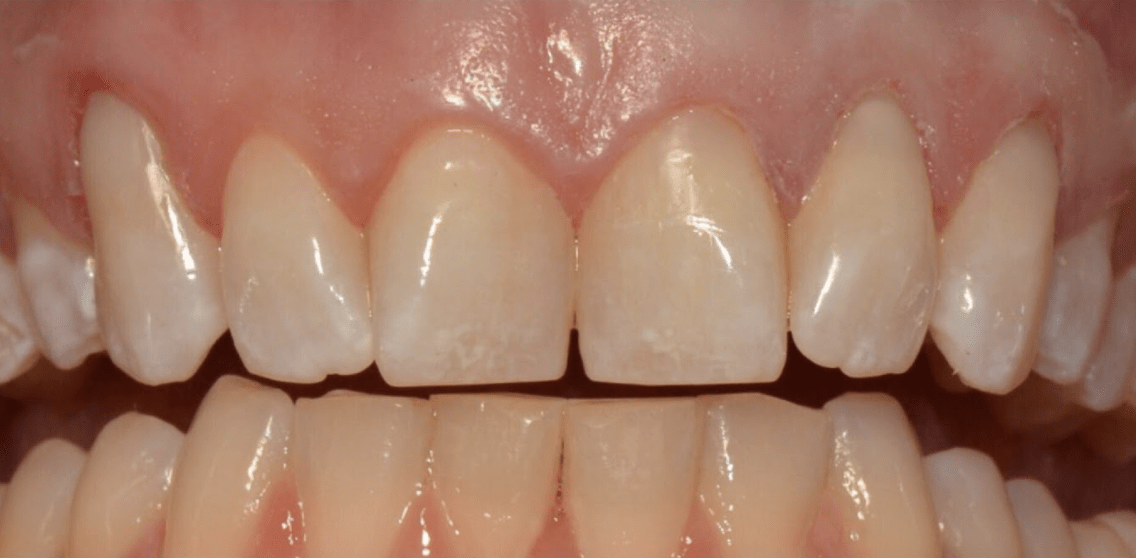 Dental Bonding Before, undefined undefined - 320