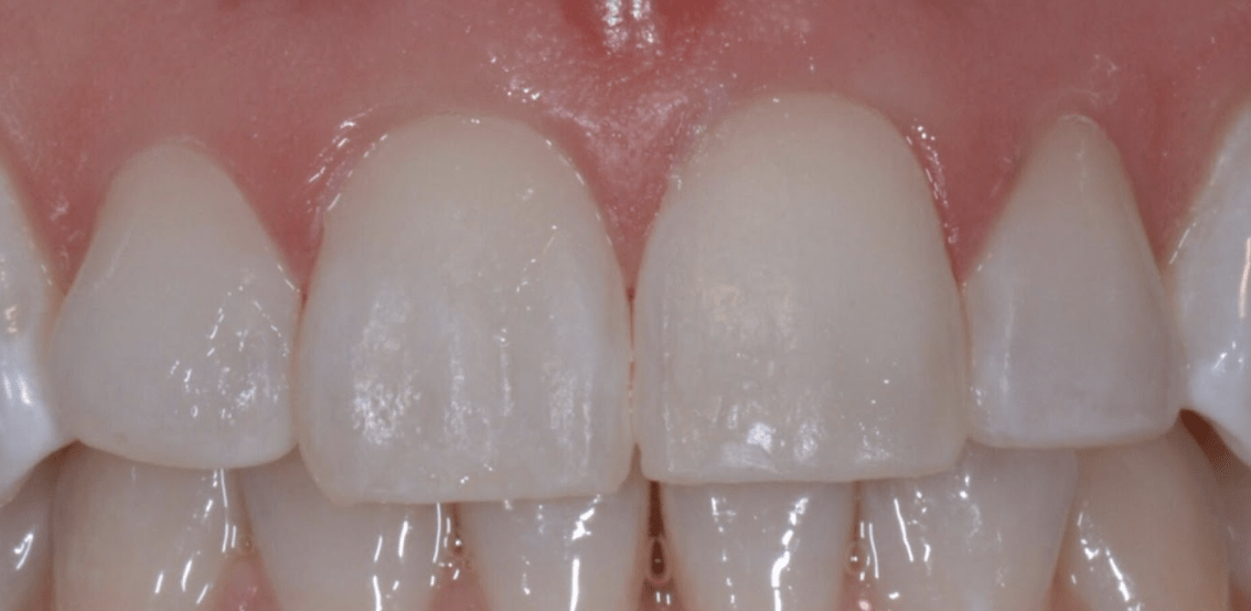 ClearCorrect After, undefined undefined - 321