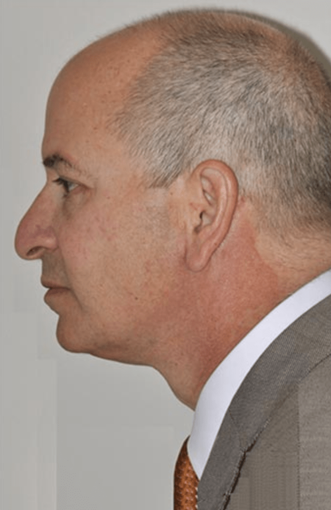 Neck Lift After, undefined undefined - 333
