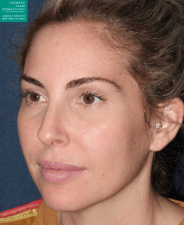 Dermal Fillers & Injectables Before, undefined undefined - 342