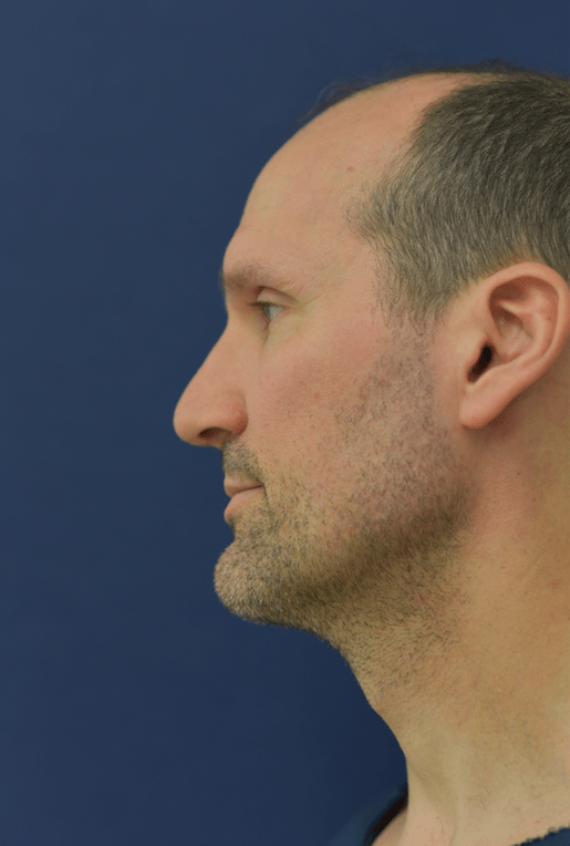 Revision Rhinoplasty After, undefined undefined - 381