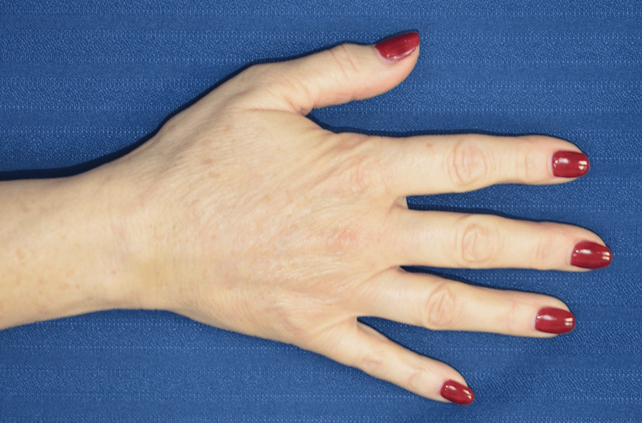 Hand Rejuvenation with Fat Transfer After, undefined undefined - 546