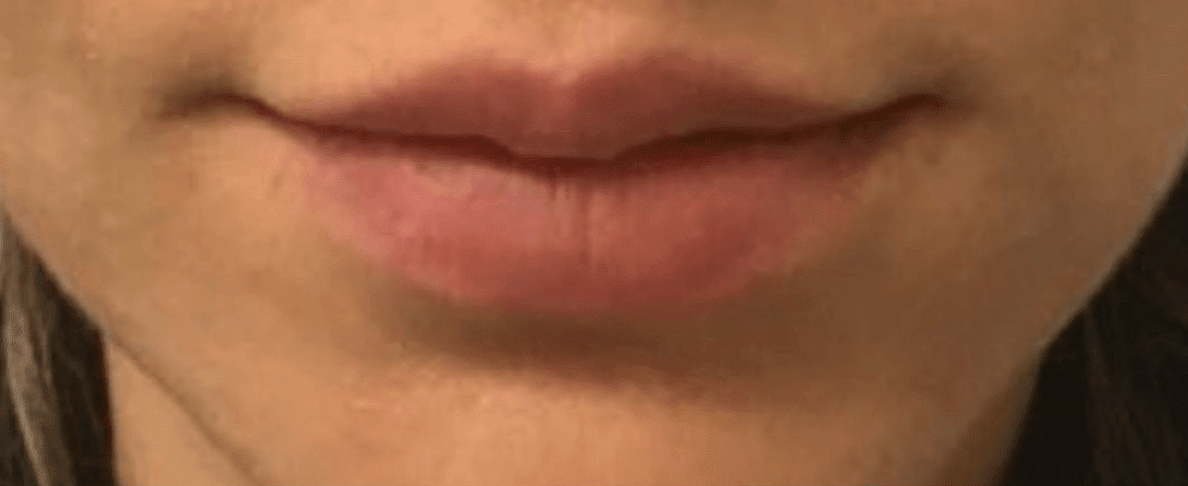 Lip Augmentation and Injections Before, undefined undefined - 558