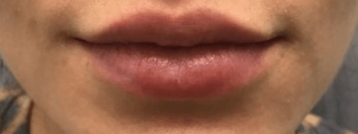 Lip Augmentation and Injections After, undefined undefined - 558
