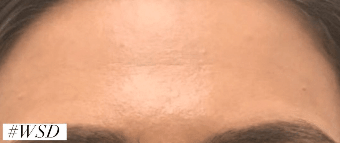 Botox After, undefined undefined - 567