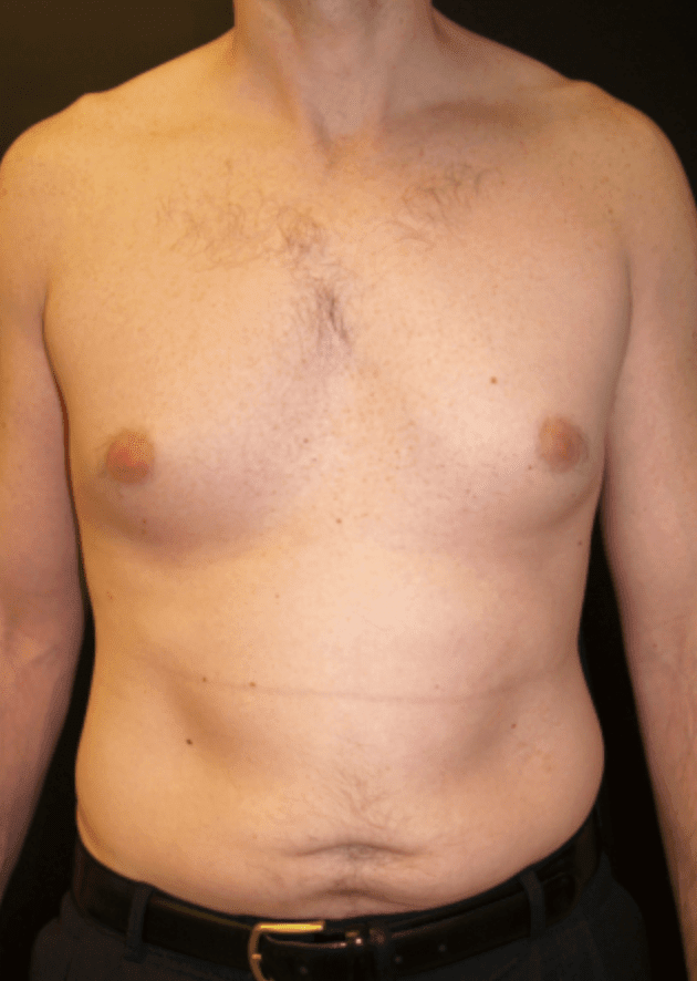 Male Breast Reduction (Gynecomastia Surgery) Before, undefined undefined - 595