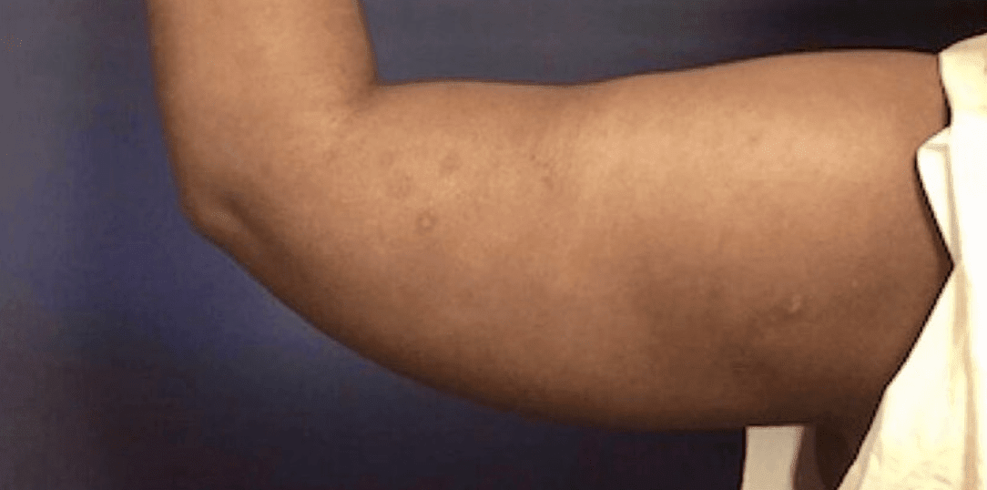 Liposculpture Before, undefined undefined - 600