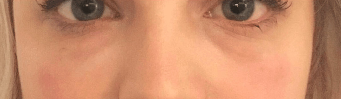 Under Eye Filler After, undefined undefined - 607
