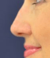 Liquid Rhinoplasty Before, undefined undefined - 619
