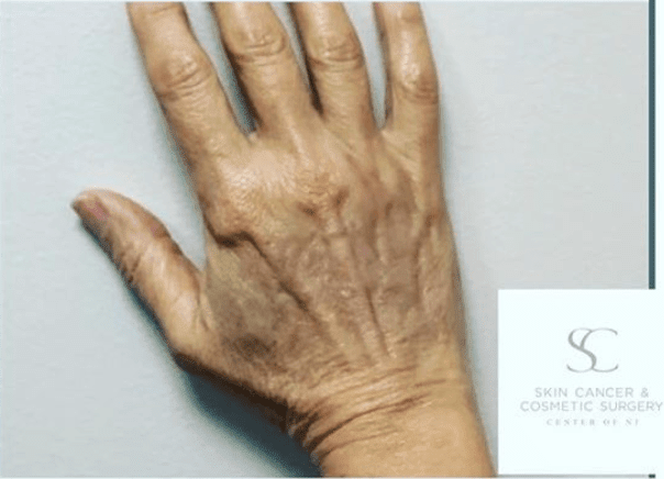 Hand Rejuvenation After, undefined undefined - 653