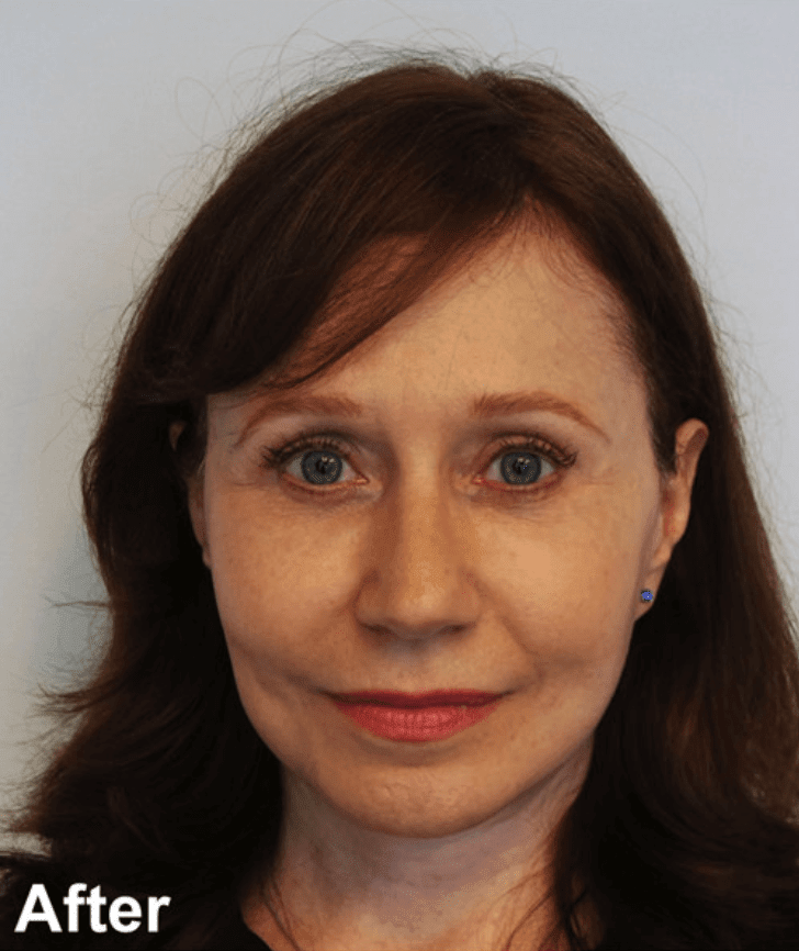 Facelift After, undefined undefined - 796
