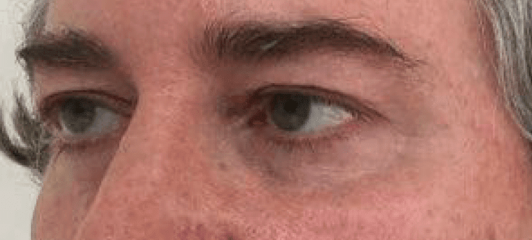 Under Eye Filler Before, undefined undefined - 848
