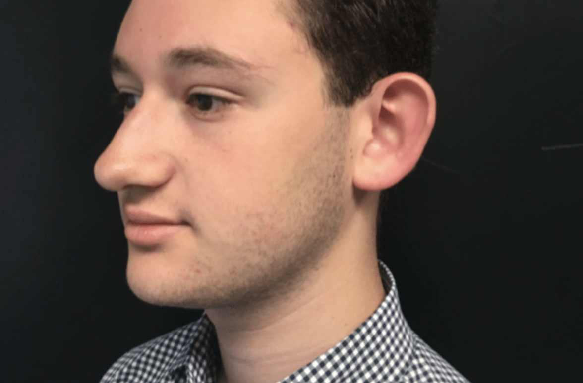 Rhinoplasty Before, undefined undefined - 905