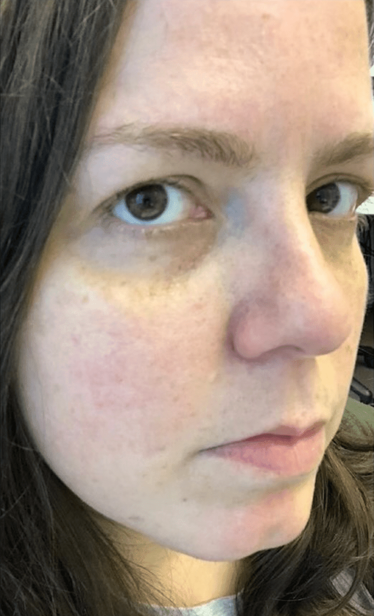 Intense Pulsed Light After, undefined undefined - 923