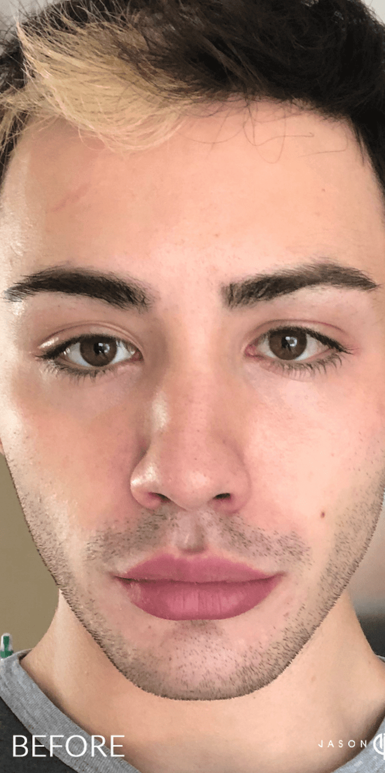 Chemical Peels Before, undefined undefined - 924