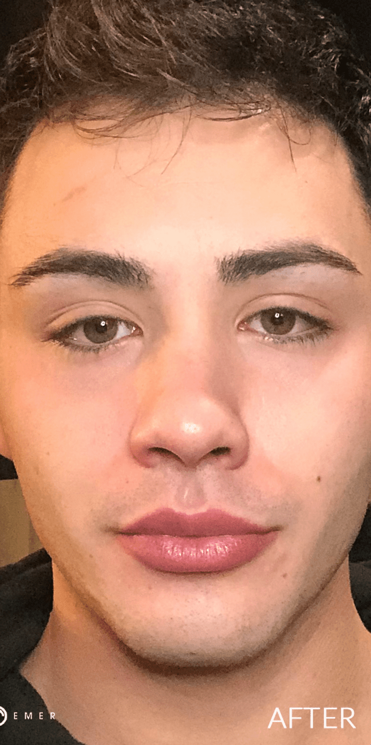 Chemical Peels After, undefined undefined - 924