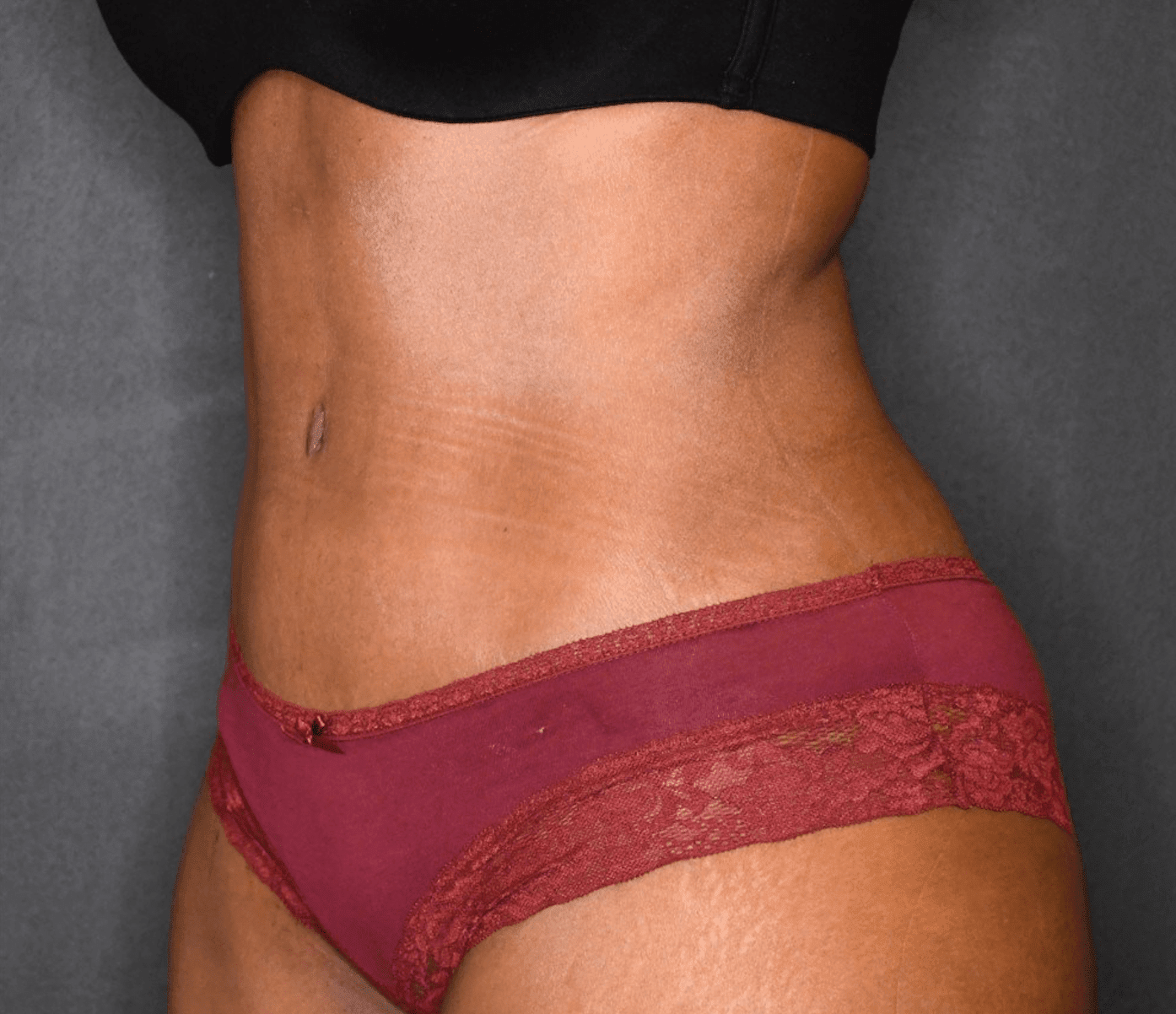 Tummy Tuck (Abdominoplasty) After, undefined undefined - 946
