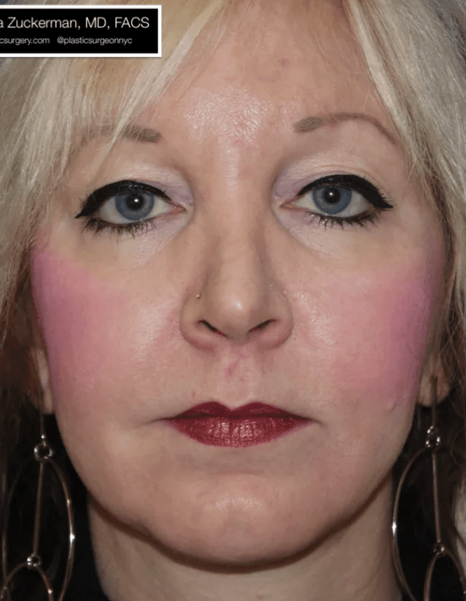 Facelift After, undefined undefined - 947