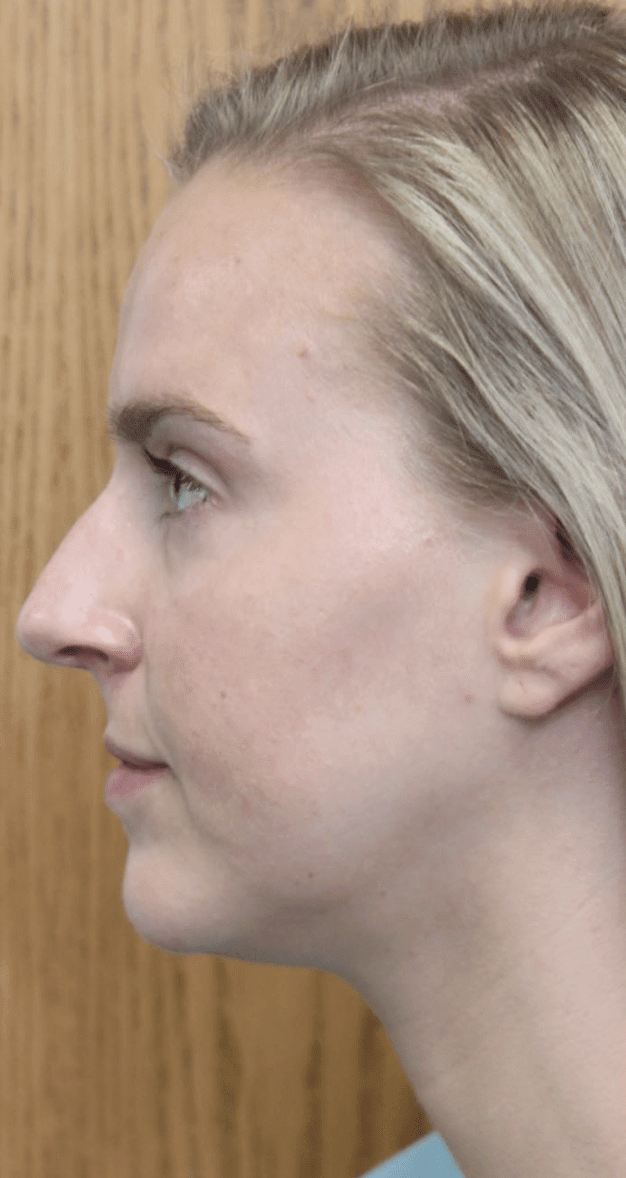 Chin Augmentation with Soft Tissue Fillers After, undefined undefined - 980