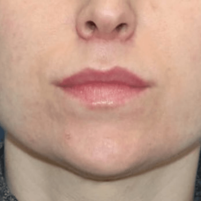 Lip Lift After, undefined undefined - 1027