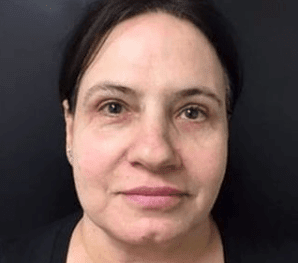 Blepharoplasty After, undefined undefined - 1035
