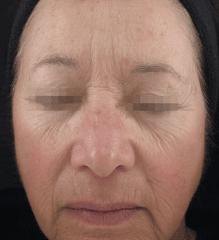 Microneedling with Radiofrequency (RF) Before, undefined undefined - 1039