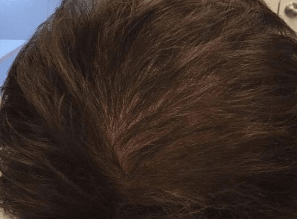 Platelet-Rich Plasma (PRP) Injections for Hair Loss After, undefined undefined - 1040