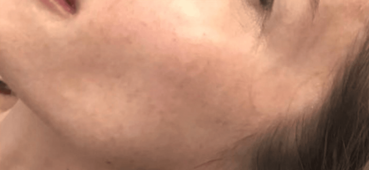 Chemical Peels After, undefined undefined - 1041