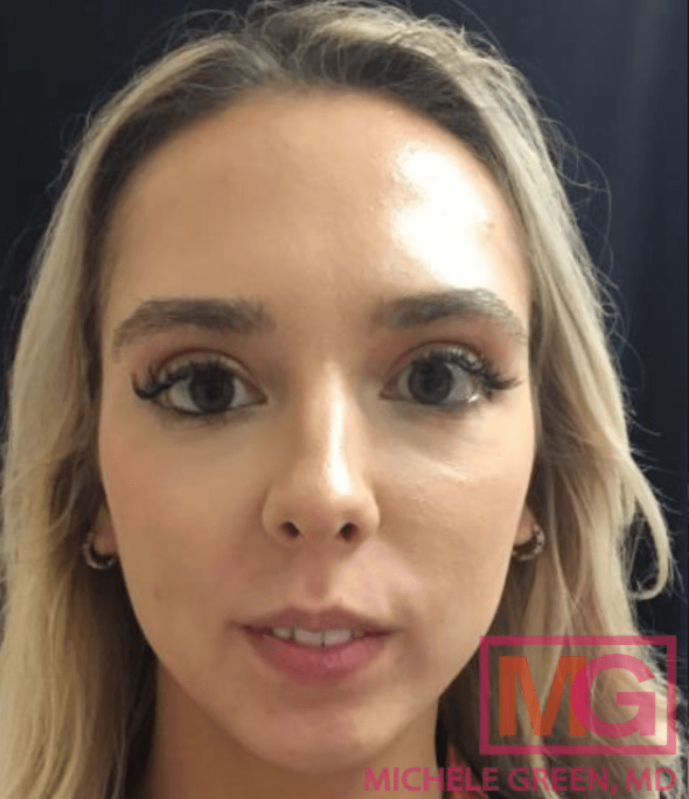 Lip Augmentation and Injections Before, undefined undefined - 1073
