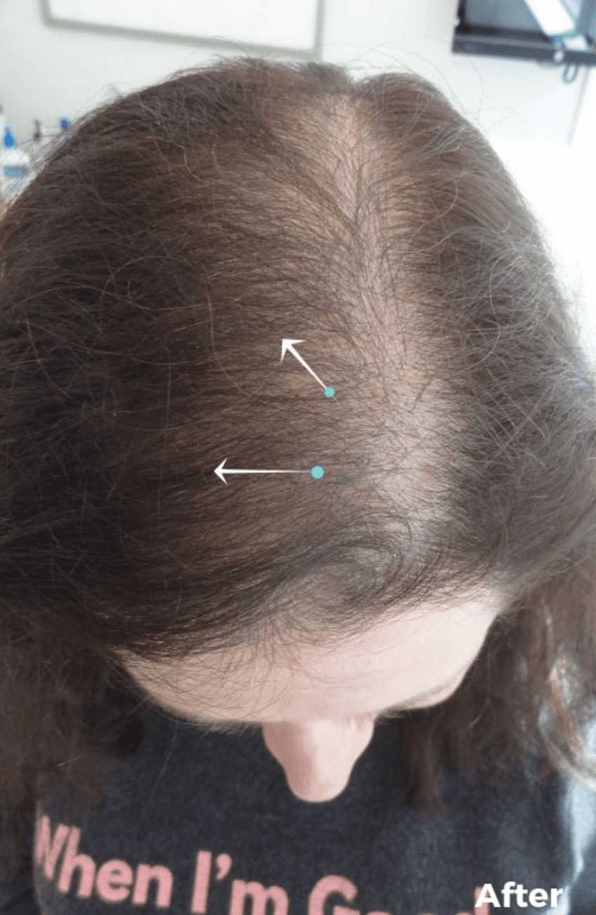 Platelet-Rich Plasma (PRP) Injections for Hair Loss After, undefined undefined - 1085