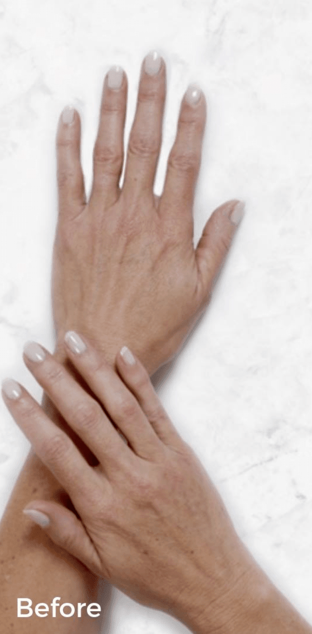 Hand Rejuvenation with Dermal Fillers Before, undefined undefined - 1089