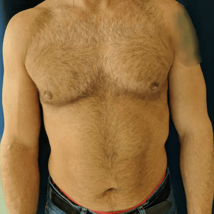 Male Breast Reduction (Gynecomastia Surgery) After, undefined undefined - 1145