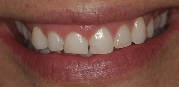 Dental Veneers Before, undefined undefined - 1226